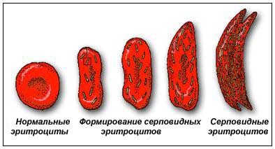 Серповидноклеточная анемия и типы ее наследования.