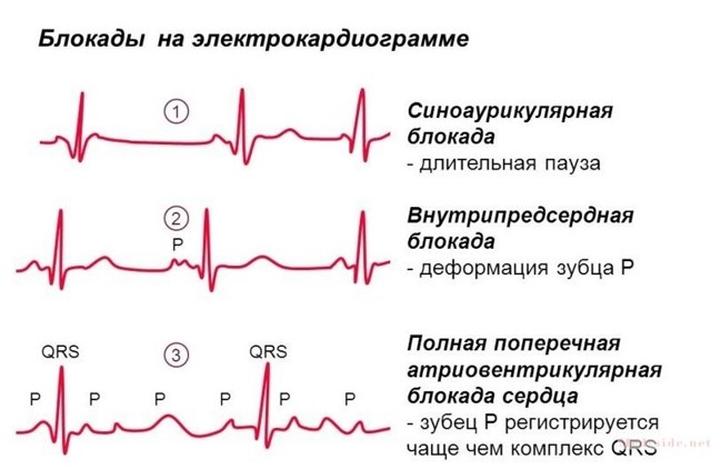 Блокады сердца на экг - Всё о сердце