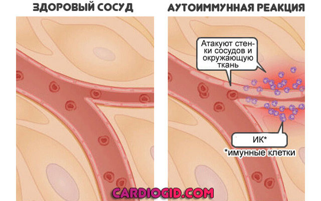 Нейтропения и ее причины. Лекарственная нейтропения
