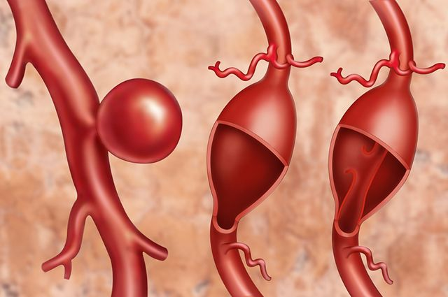 Сосуды головного мозга: заболевания, диагностика, лечение