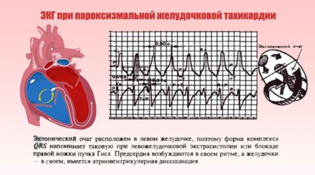 Тахикардия - причины, признаки, симптомы и лечение