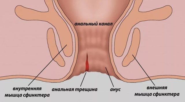 Глицериновые свечи после родов со швами. Применение глицериновых свеч после родов