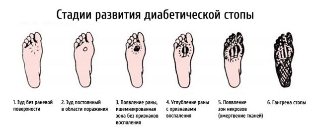 Гангрена при сахарном диабете - причины, признаки и лечение