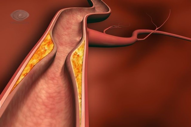Артериит Такаясу — обследование, диагноз