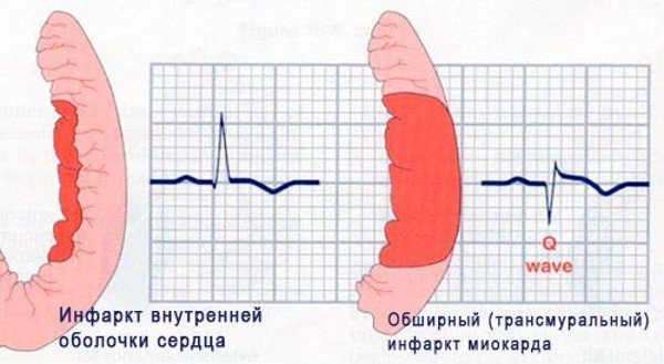 Инфаркт задней стенки сердца прогноз - Всё о сердце