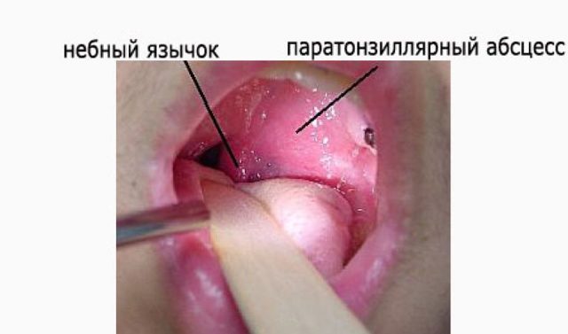 Паратонзиллярный абсцесс: лечение, фото, симптомы