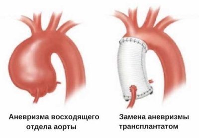 Аневризма аорты восходящего отдела, расширение аорты - лечение. Протезирование аорты в СПб