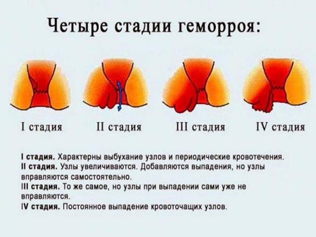 Геморрой у мужчин – причины, признаки, симптомы, лечение и профилактика геморроя у мужчин