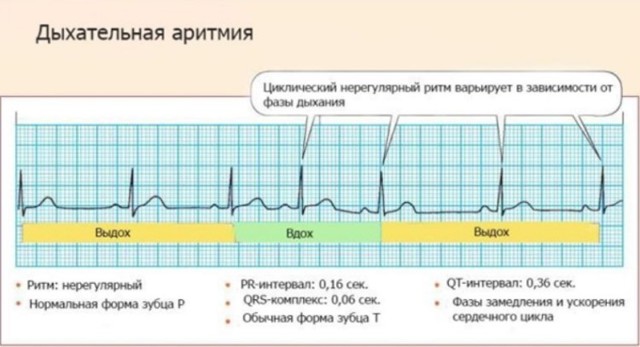 Синусовая аритмия при беременности и восстановление работы сердца будущей мамы