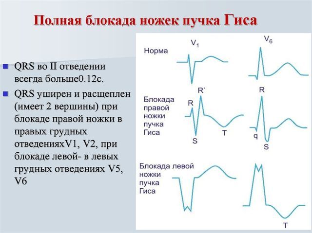 Неполная блокада правой ножки пучка Гиса - ЭКГ