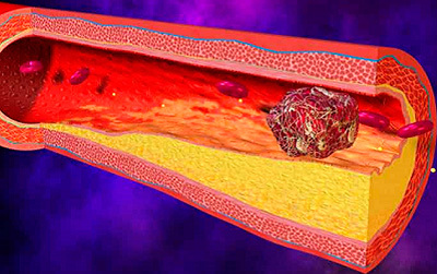 Свертываемость крови – норма