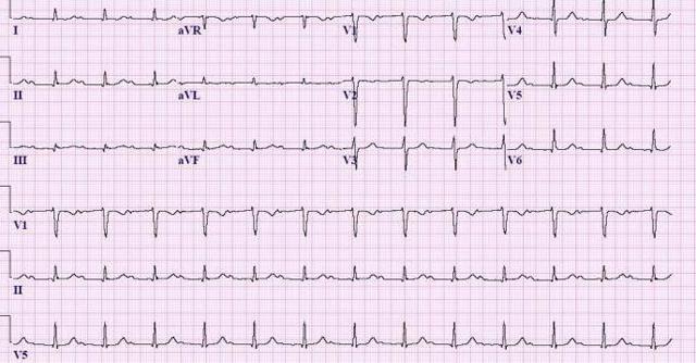 Неполная блокада правой ножки пучка Гиса – вид на ЭКГ