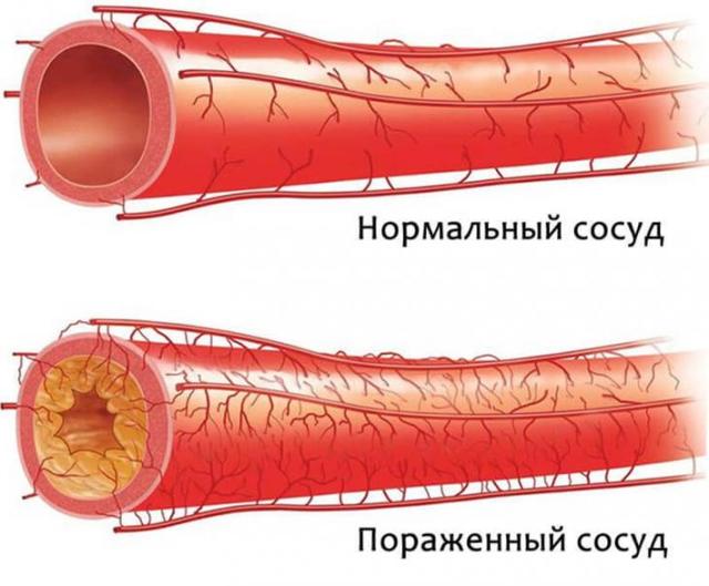 Высокое нижнее давление – причины и интересные факты