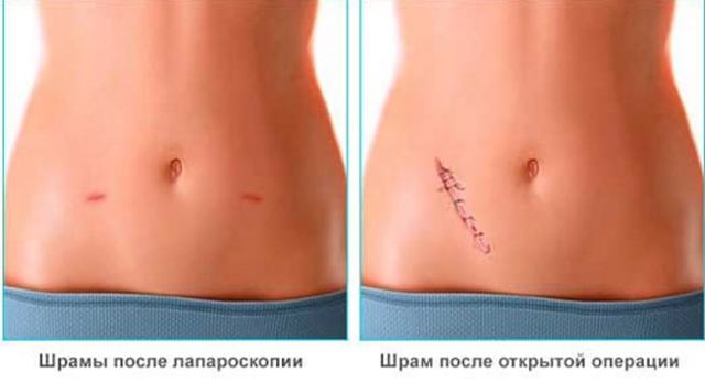 Киста яичника у женщин – причины, признаки и симптомы кисты левого и правого яичника у женщин. Последствия и разрыв кисты