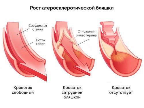 Реноваскулярная гипертензия - лечение, причины