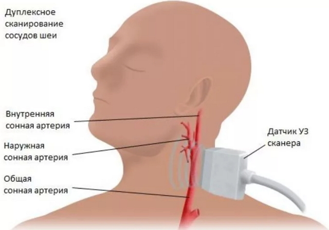 Дуплексное сканирование сосудов головного мозга и шеи: что показывает