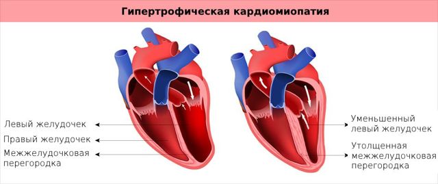Кардиомиопатия сердца: симптомы и лечение