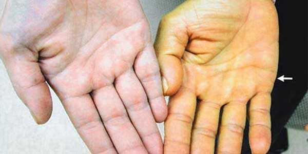 Анализ крови на билирубин - что это такое, как обозначается