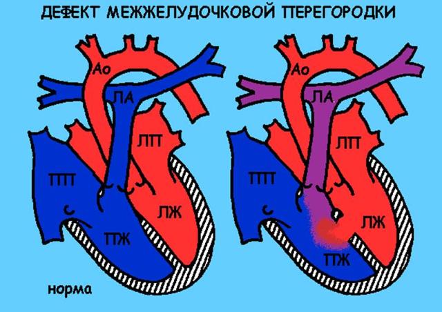 Операция при пороке сердца у ребенка как проходит -