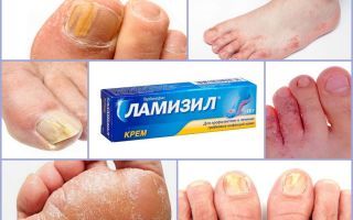Ламизил цена в Томске от 559 руб., купить Ламизил, отзывы и инструкция по применению