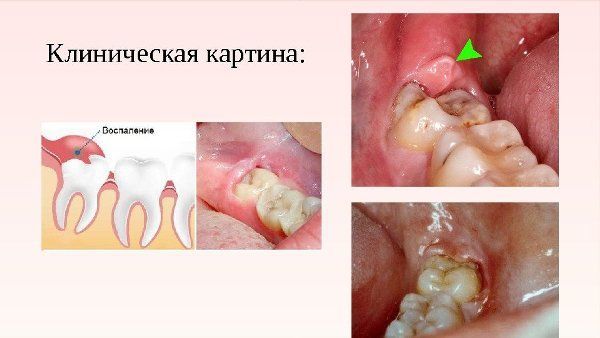 Перикоронарит зуба мудрости - формы, симптомы и лечение