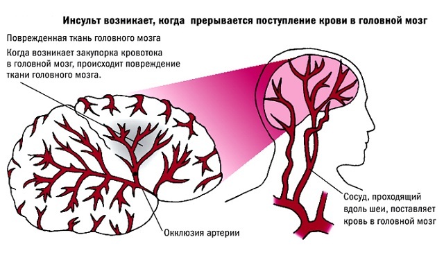 Инфаркт головного мозга - Мое Здоровье