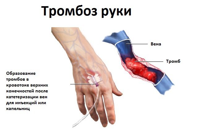 Тромбофлебит верхних конечностей: симптомы и лечение, фото