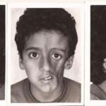 Системная склеродермия - диагностика, лечение, прогноз