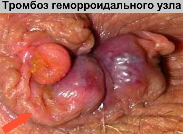 Тромбоз наружного геморроидального узла: причины и лечение