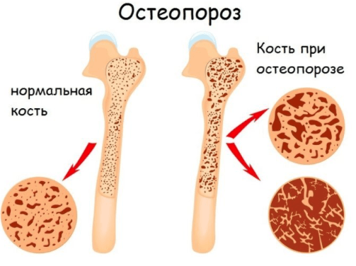 Щелочная фосфатаза в крови повышена/понижена – что делать?