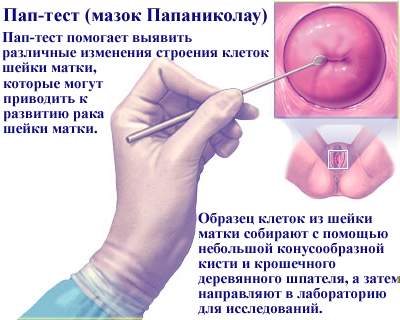 Онкоцитология шейки матки - мазок на онкоцитологию. Цитограмма воспаления с расшифровкой