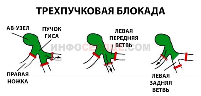 Неполная блокада левой ножки пучка Гиса - причины, лечение