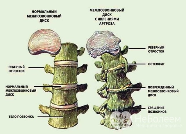 Остеохондроз грудной клетки