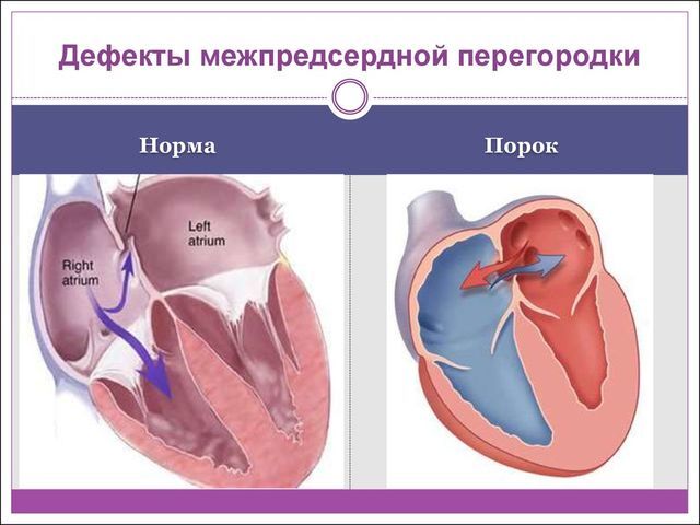 Дефект межпредсердной перегородки (ДМПП): причины, симптомы и особенности лечения