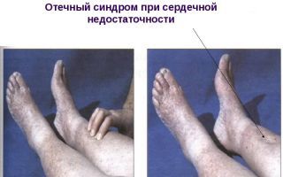 Отеки ног при сердечной недостаточности