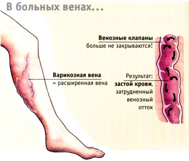 Гепариновая мазь при геморрое: как применять во время беременности