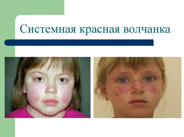 Красная волчанка - что это за болезнь? (с фото)