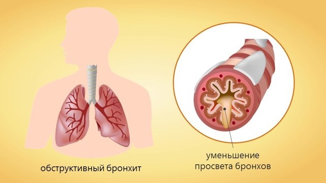 Острый обструктивный бронхит - причины, симптомы, лечение