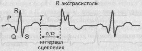 Монотопные экстрасистолы