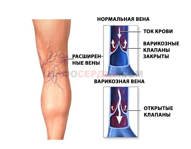 Венотоники при варикозе ног - гель, уколы, отзывы