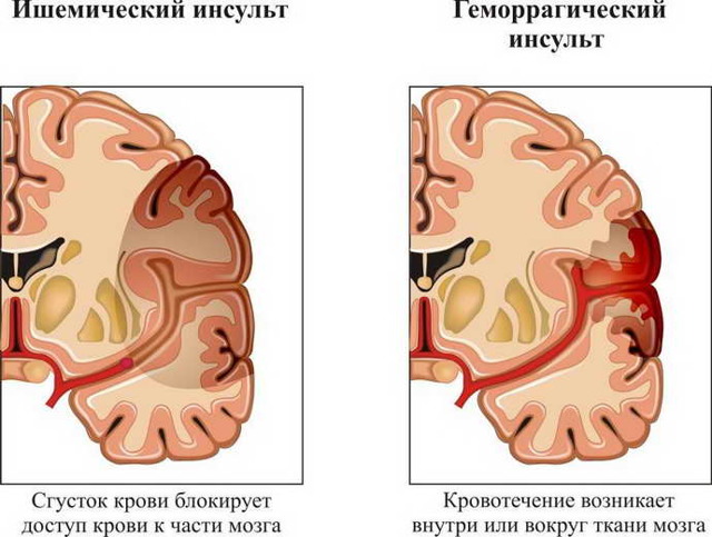 Таблетки от инсульта