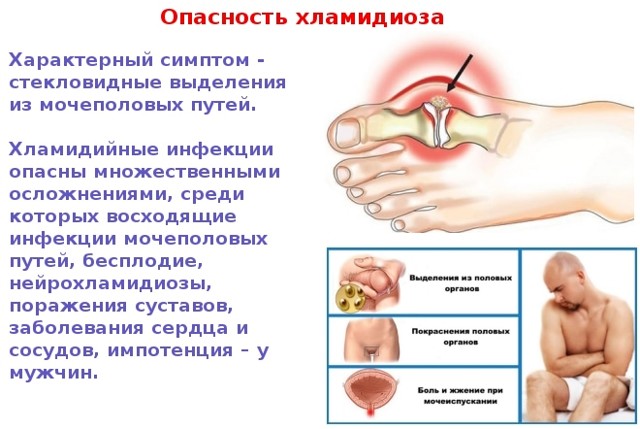 Хламидиоз: у мужчин, женщин; фото, симптомы и лечение
