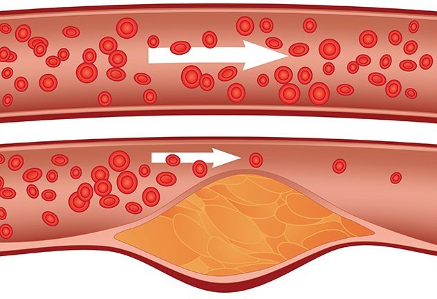 Снижение холестерина: как снизить повышенный холестерин в крови