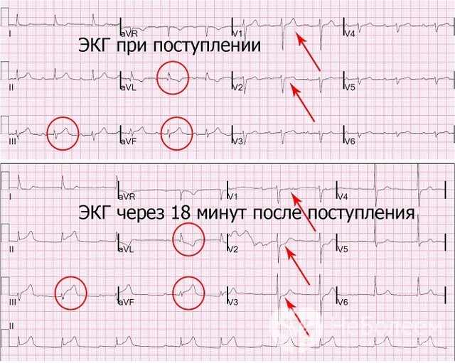 ЭКГ при инфаркте миокарда: фото пленок и расшифровка признаков