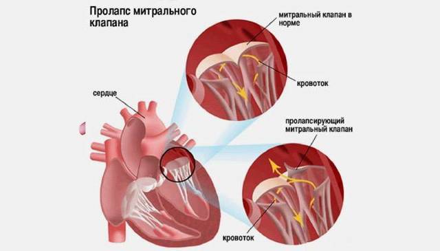 ПМК 1 степени - симптомы, лечение, диагностика