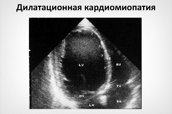 Эхо КГ сердца что это такое, как делают