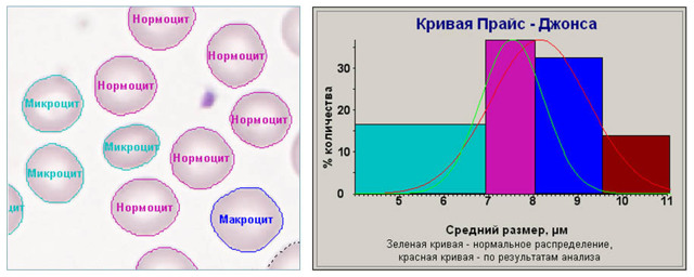 Анизоцитоз в общем анализе крови: что это, виды, причины