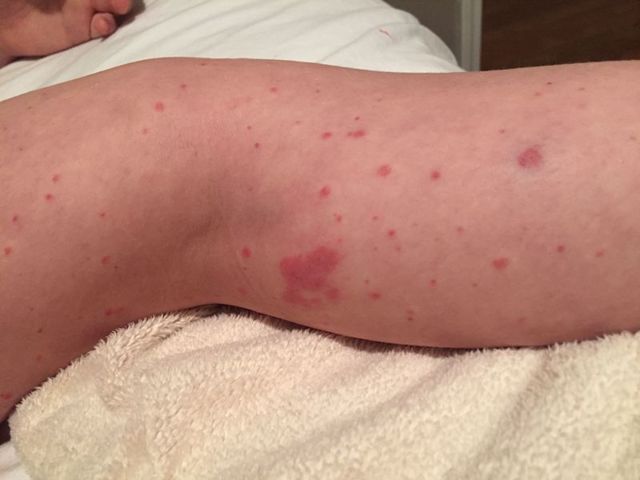 Викасол - таблетки и ампулы: цена и инструкция по применению лекарства