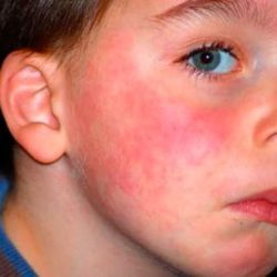 Аллергия после приема антибиотиков лечение — Аллергия