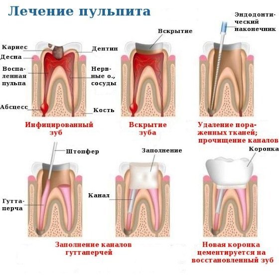 Пульпит зуба: симптомы, причины, лечение